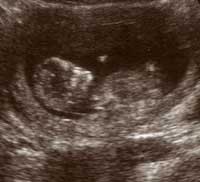 The twelve week scan.  Looks like static on the telly to me!